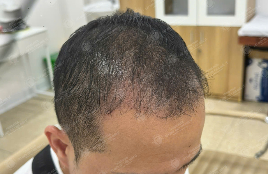 Trần Quốc Hoàn - Cấy tóc đường chữ M 9