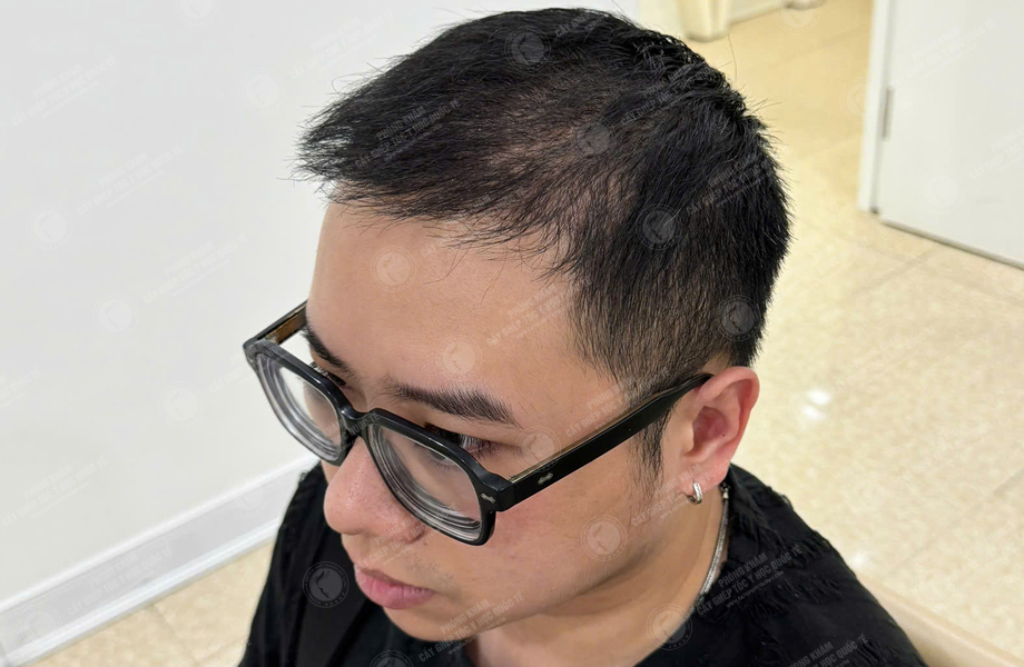 Bùi Văn Nguyên - Cấy tóc đường chữ M 9