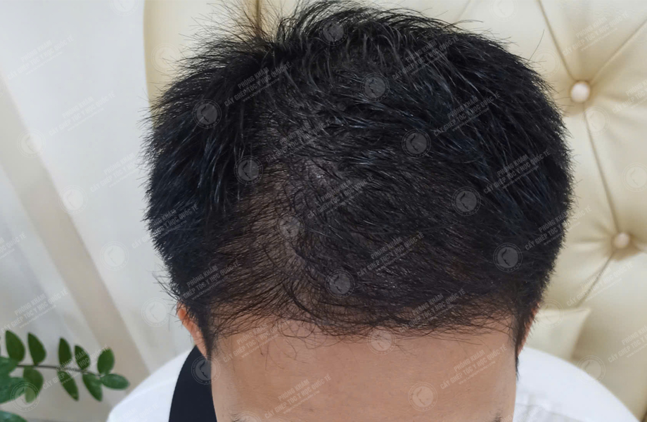 Lê Thanh Sơn - Cấy tóc đường chữ M 9