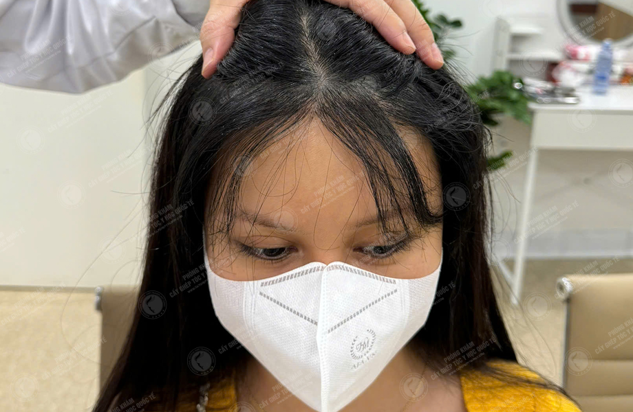 Trần Thị Huyền - Cấy tóc đường chữ M 9