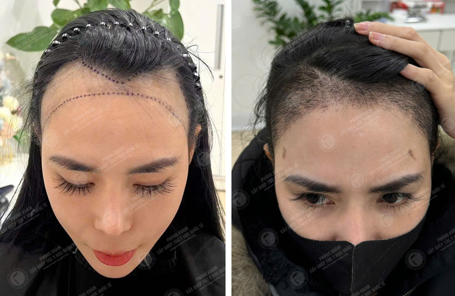  Nguyễn Tuyết Mai - Điều chỉnh đường chân tóc 1