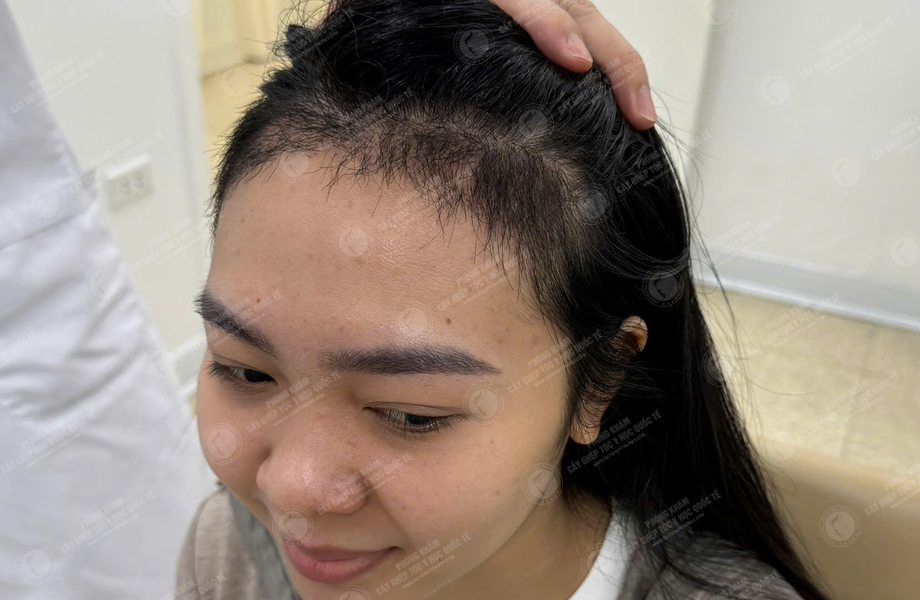 Nguyễn Hồng Hạnh - Cấy tóc đường chữ M 9