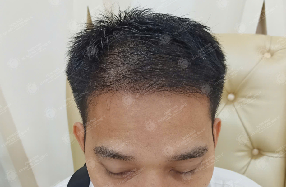 Lê Thanh Sơn - Cấy tóc đường chữ M 10