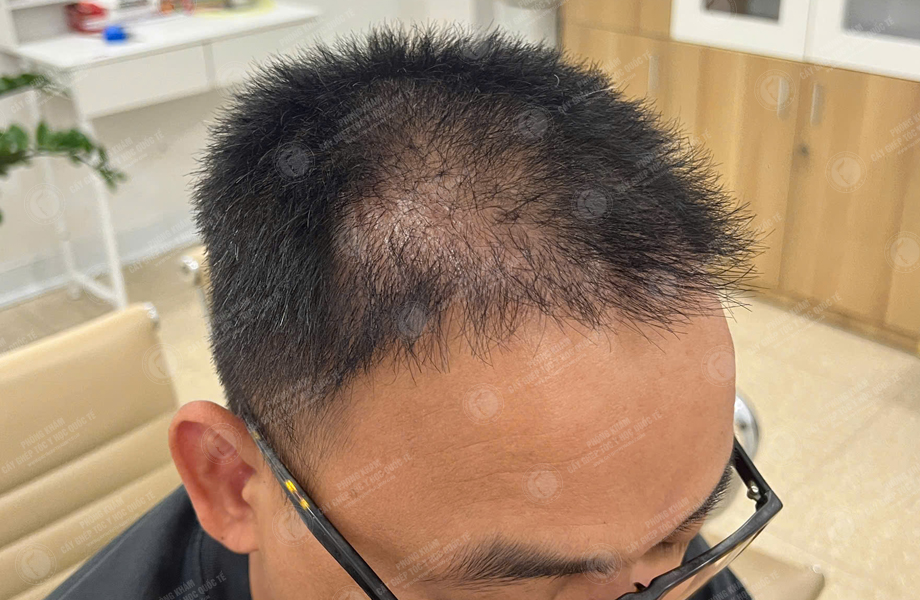 Lê Thanh Tùng - Cấy tóc đường chữ M 10