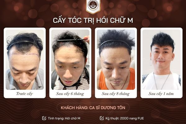Làm PRP bao lâu mọc tóc: Thời gian, hiệu quả và giải pháp tối ưu