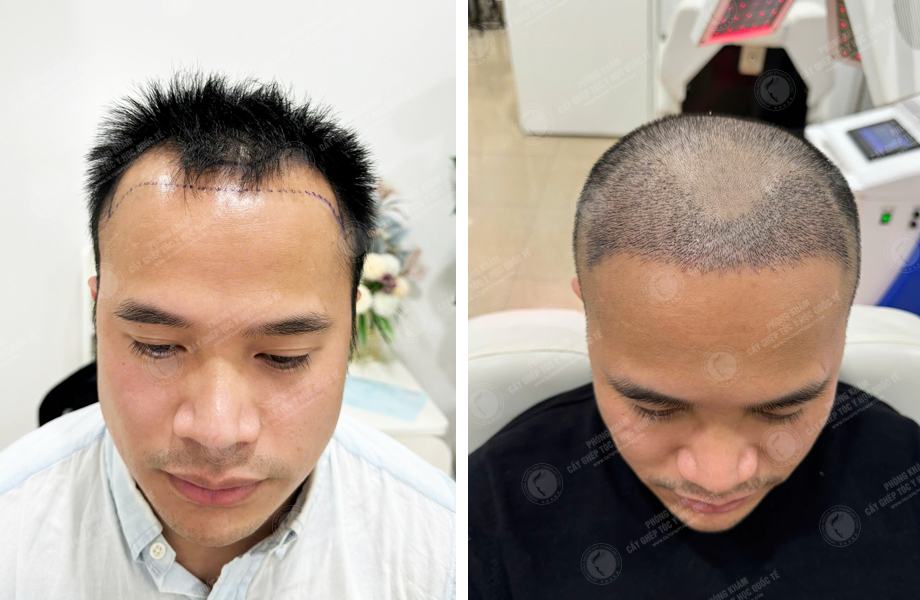  Nguyễn Tuấn Sơn - Cấy tóc đường chữ M 1