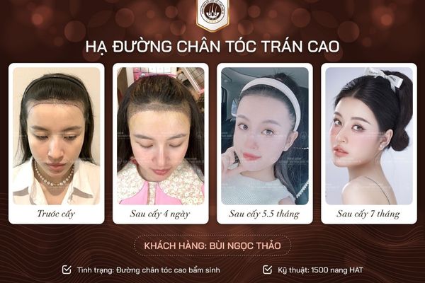 Tóc mỏng có cấy tóc được không? Chuyên gia giải đáp từ A - Z