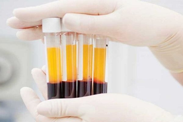 PRP trị rụng tóc và những điều cần biết trước khi thực hiện liệu trình 