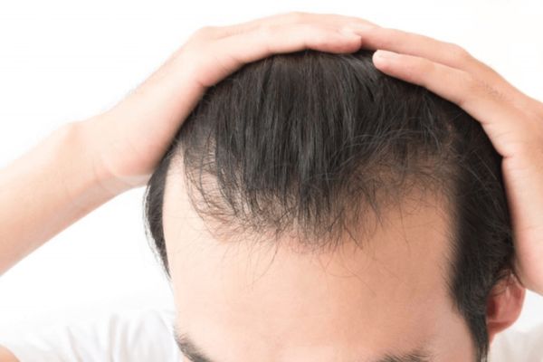 Hói đầu ở nam giới – Nguyên nhân, dấu hiệu và giải pháp hiệu quả Hói đầu ở nam giới – Nguyên nhân, dấu hiệu và giải pháp hiệu quả