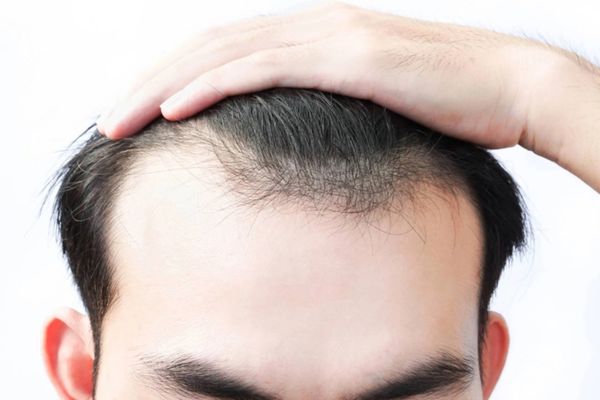 Bị hói đầu có nên cấy tóc không? Chia sẻ từ Thạc sĩ - Bác sĩ Nguyễn Quốc Tuấn
