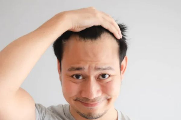 Ngưng Minoxidil tóc có rụng lại không? Chuyên gia giải đáp