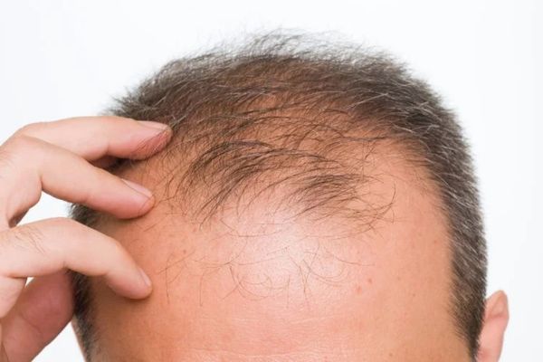 PRP có dùng cho người cấy tóc không? Sự thật bạn cần biết trước khi điều trị 