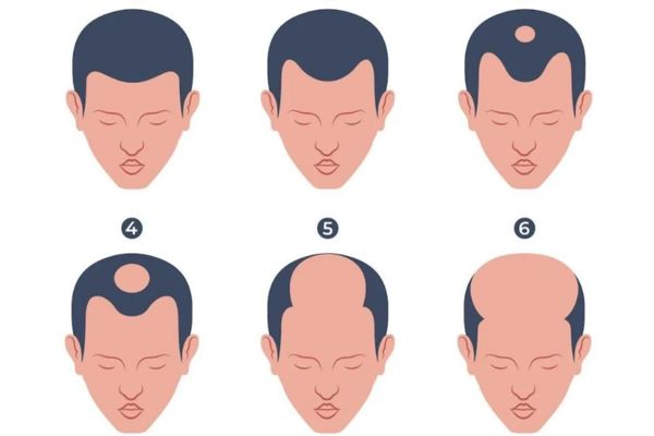 Cấy tóc ở vùng đỉnh đầu bị thưa có hiệu quả không? Bác sĩ giải đáp