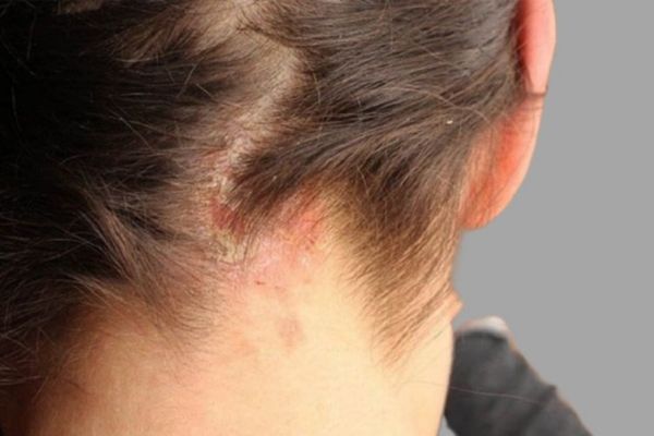 Ngưng Minoxidil tóc có rụng lại không? Chuyên gia giải đáp