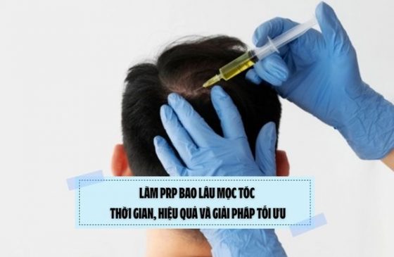 Làm PRP bao lâu mọc tóc: Thời gian, hiệu quả và giải pháp tối ưu