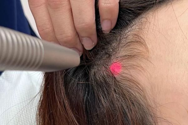 Trị rụng tóc bằng laser: Những điều cần biết trước khi lựa chọn