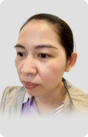 cấy tóc trị hói