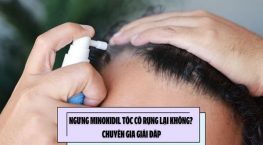 Ngưng Minoxidil tóc có rụng lại không? Chuyên gia giải đáp