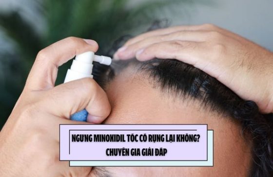 Ngưng Minoxidil tóc có rụng lại không? Chuyên gia giải đáp