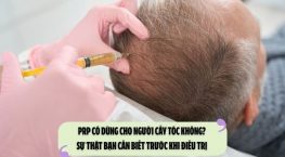 PRP có dùng cho người cấy tóc không? Sự thật bạn cần biết trước khi điều trị 