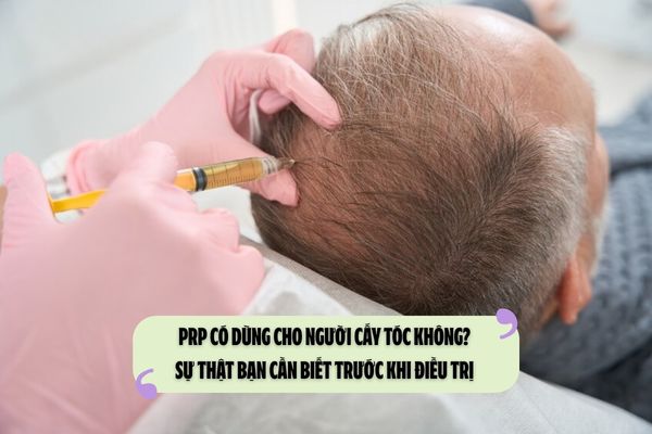 PRP có dùng cho người cấy tóc không? Sự thật bạn cần biết trước khi điều trị 