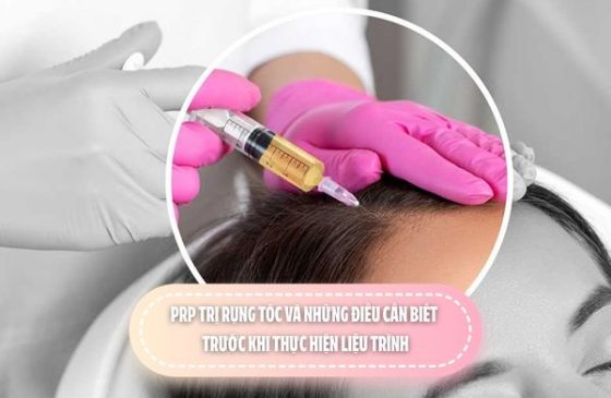 PRP trị rụng tóc và những điều cần biết trước khi thực hiện liệu trình