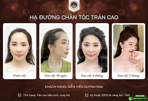 Địa chỉ cấy tóc uy tín tại TPHCM được nhiều người nổi tiếng và KOL tin chọn