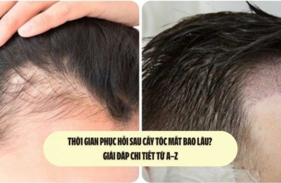 Thời gian phục hồi sau cấy tóc mất bao lâu? Giải đáp chi tiết từ A–Z