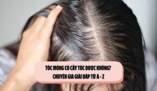 Tóc mỏng có cấy tóc được không? Chuyên gia giải đáp từ A – Z