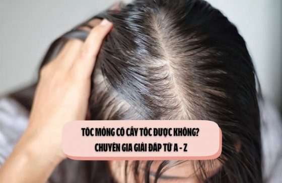 Tóc mỏng có cấy tóc được không? Chuyên gia giải đáp từ A - Z