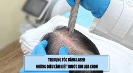 Trị rụng tóc bằng laser: Những điều cần biết trước khi lựa chọn