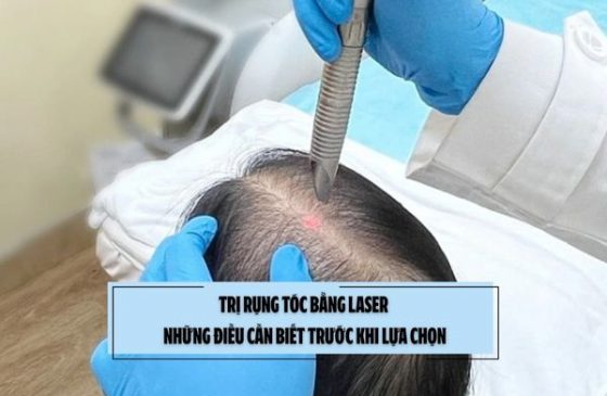 Trị rụng tóc bằng laser: Những điều cần biết trước khi lựa chọn