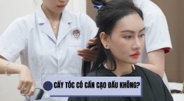 Cấy tóc có phải cạo đầu không? Hướng dẫn lựa chọn phương pháp phù hợp