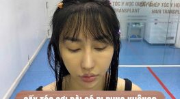 Cấy tóc dài có bị rụng không? Sự thật cần biết trước khi quyết định