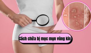 Bật mí cách chữa bị mọc mụn vùng kín nhanh khỏi, không để lại sẹo
