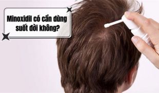 [Giải Đáp] : Minoxidil có cần dùng suốt đời không?