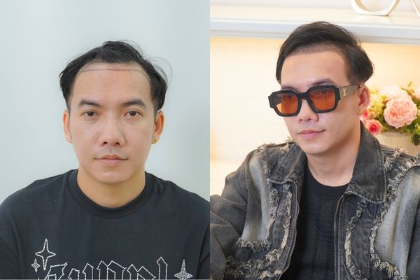 Địa chỉ cấy tóc uy tín tại TPHCM được nhiều người nổi tiếng và KOL tin chọn