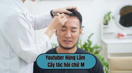 Youtuber Hùng Lâm cấy tóc hói chữ M và màn “lột xác” khiến nhiều người bất ngờ