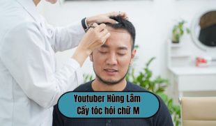 Youtuber Hùng Lâm cấy tóc hói chữ M và màn “lột xác” khiến nhiều người bất ngờ
