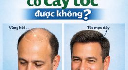 Bị hói có cấy tóc được không? Giải đáp chi tiết từ A đến Z