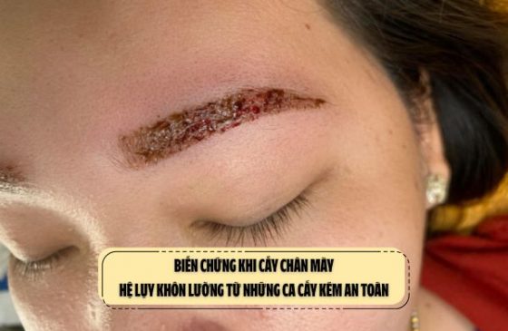 Biến chứng khi cấy chân mày: Hệ lụy khôn lường từ những ca cấy kém an toàn