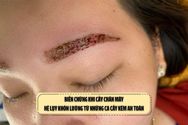 Biến chứng khi cấy chân mày: Hệ lụy khôn lường từ những ca cấy kém an toàn
