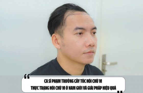 Ca sĩ Phạm Trưởng cấy tóc hói chữ M – Thực trạng hói chữ M ở nam giới và giải pháp hiệu quả