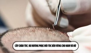 Cấy chân tóc: Xu hướng phục hồi tóc bền vững cho nam và nữ