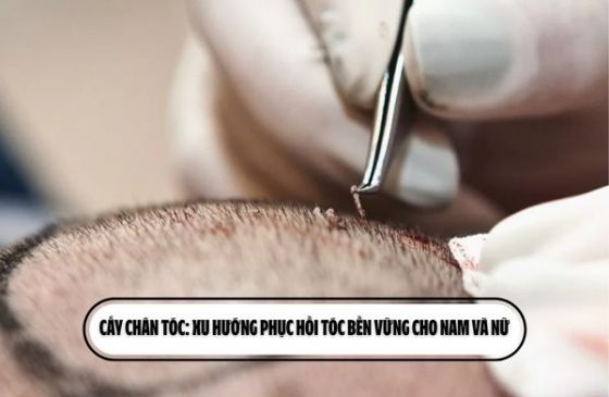 Cấy chân tóc: Xu hướng phục hồi tóc bền vững cho nam và nữ