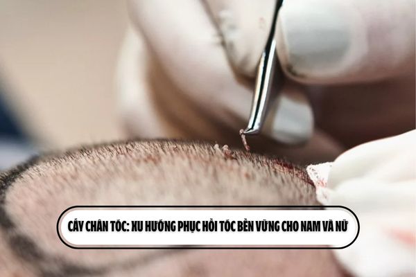 Cấy chân tóc: Xu hướng phục hồi tóc bền vững cho nam và nữ Cấy chân tóc: Xu hướng phục hồi tóc bền vững cho nam và nữ