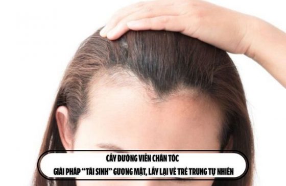 Cấy đường viền chân tóc – Giải pháp “tái sinh” gương mặt, lấy lại vẻ trẻ trung tự nhiên