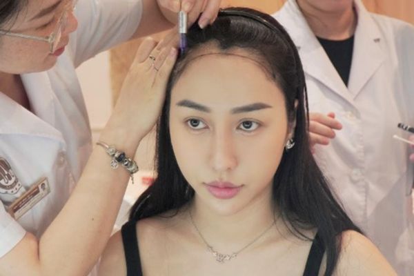 Hạ đường chân tóc có đau không? Sự thật ai cũng nên biết trước khi làm