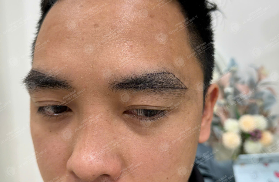 Lý Văn Cường - Cấy lông mày 2