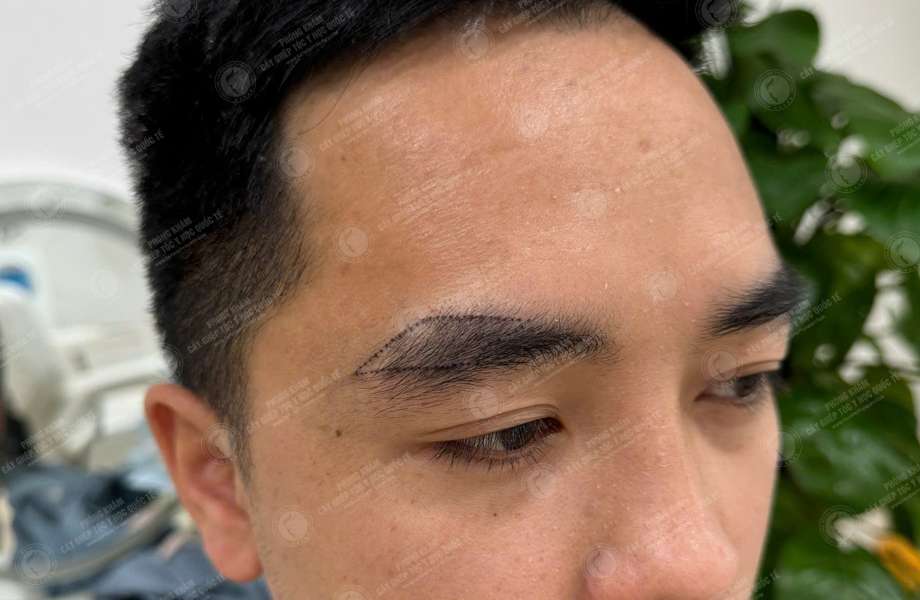 Lý Văn Cường - Cấy lông mày 3